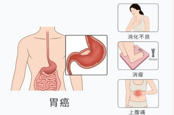 魔高一尺，道高一丈：胃腸鏡—消化道早癌克星