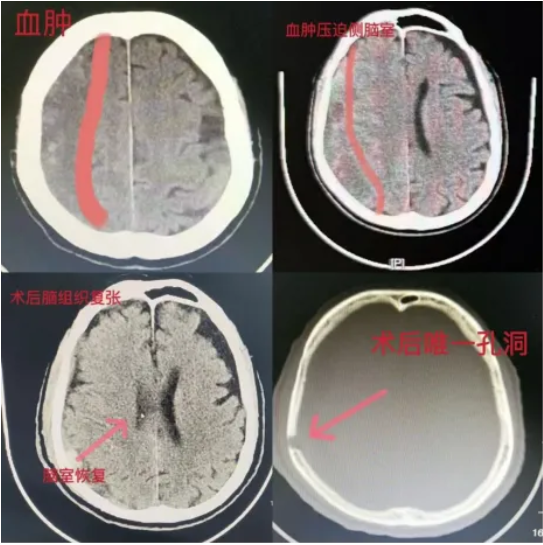 【健康科普】警惕老年人的沉默殺手，認(rèn)識(shí)慢性硬膜下血腫