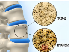沉默的骨骼“小偷”：揭秘骨質(zhì)疏松的預(yù)防與應(yīng)對(duì)